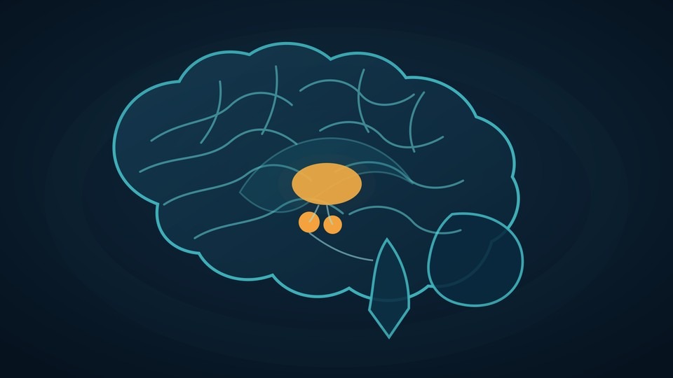 Medical illustration of thiamine deficiency brain damage that causes wet brain, or Wernicke-Korsakoff syndrome.